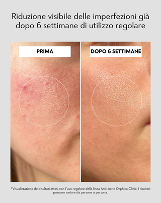 Crema giorno anti-acne con acido salicilico e azelaico per imperfezioni Anti-Acne Orphica Clinic 50 ml - 5