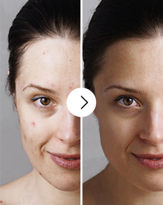 Pillole contro acne, brufoli e imperfezioni con zinco, vitamina C, E e B2 Derminax_3 - 3