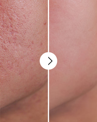 Pillole contro acne, brufoli e imperfezioni con zinco, vitamina C, E e B2 Derminax_4 - 4