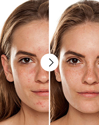 Pillole contro acne, brufoli e imperfezioni con zinco, vitamina C, E e B2 Derminax - 2