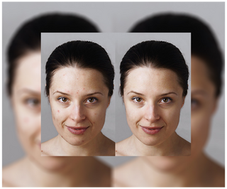 Pillole contro acne, brufoli e imperfezioni con zinco, vitamina C, E e B2 Derminax