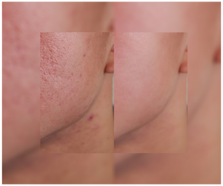 Pillole contro acne, brufoli e imperfezioni con zinco, vitamina C, E e B2 Derminax