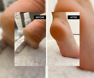 Refeet Crema Piedi Emolliente con Urea e Burro di Karitè