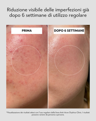 Tonico viso con niacinamide e acido azelaico Anti-Acne Orphica Clinic 200 ml - 6