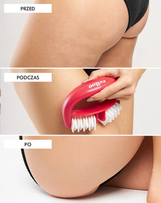 Massaggiatore anticellulite con sporgenze combatte la cellulite e riduce la tensione muscolare Crush my Celloo - 3