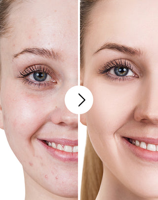 Pillole contro acne, brufoli e imperfezioni con zinco, vitamina C, E e B2 Derminax_5